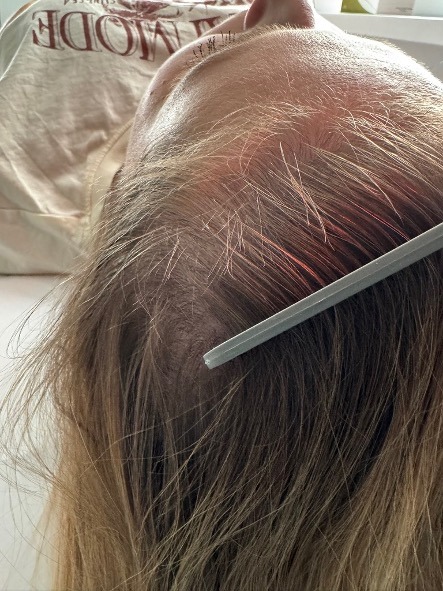 Trycholog Bydgoszcz Kobiety i problemy hormonalne a zdrowie włosów Milena Kwaśniewska, specjalizuję się w diagnostyce i leczeniu problemów skóry głowy oraz włosów, oferując profesjonalne konsultacje i indywidualnie dobrane terapie. Nowa 15, 85-119 Bydgoszcz https://milena-trycholog.pl